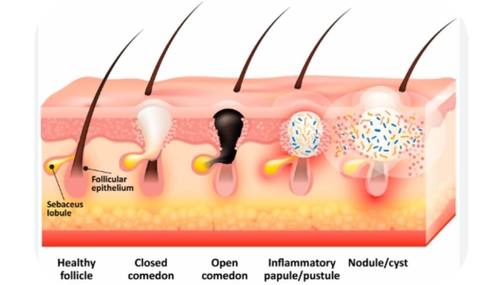 representation of the development of acne