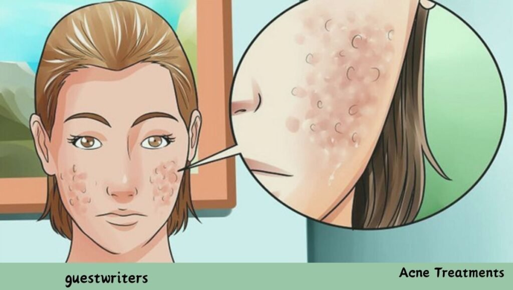 acne treatment overview