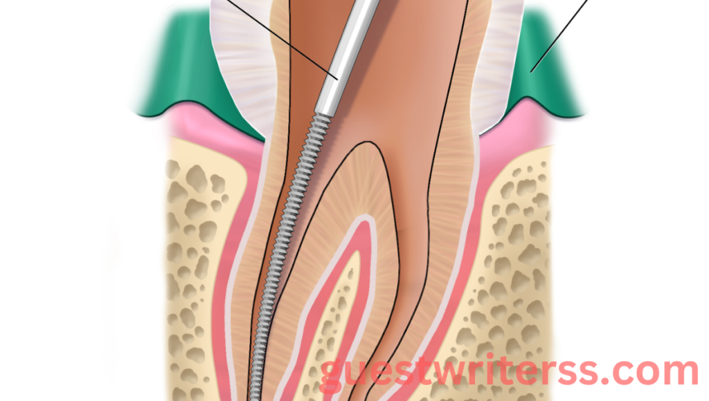 Dental Treatments Root Canal